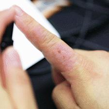 脚上怎么分辨是湿疹还是脚气（脚上怎么分辨是湿疹还是真菌感染）